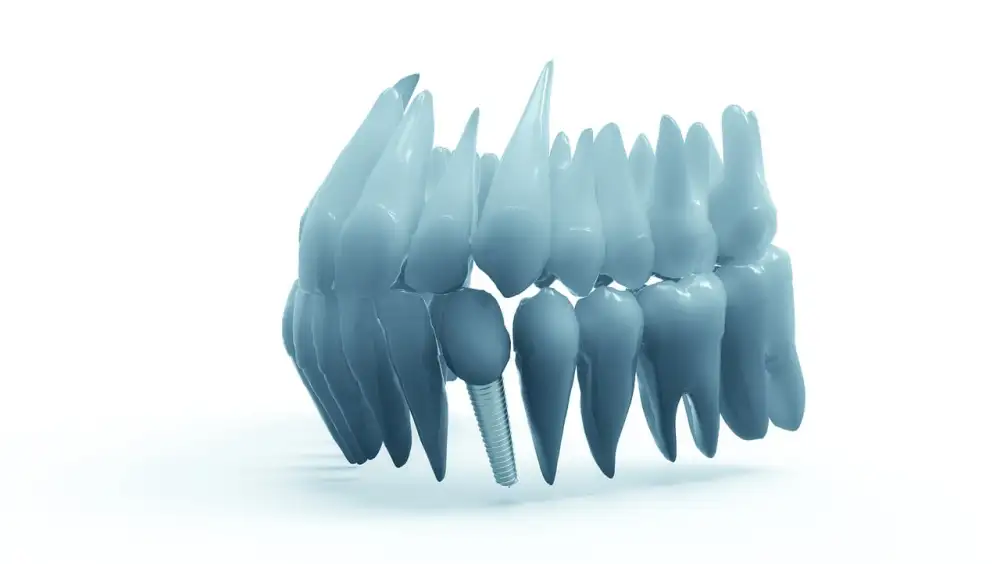 Kolik Stojí Zubní Implantát