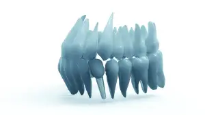 Kolik Stojí Zubní Implantát